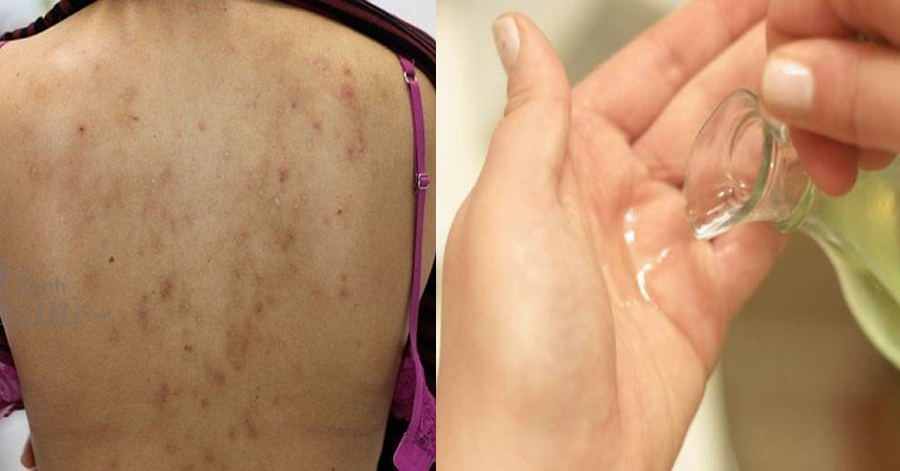 Dùng dầu dừa để dưỡng da hàng ngày mà không biết điều này chẳng khác nào bạn đang tự hủy hoại da mình