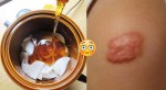 Sẹo lồi lâu năm đến mấy cũng “xẹp” ngay với hỗn hợp này