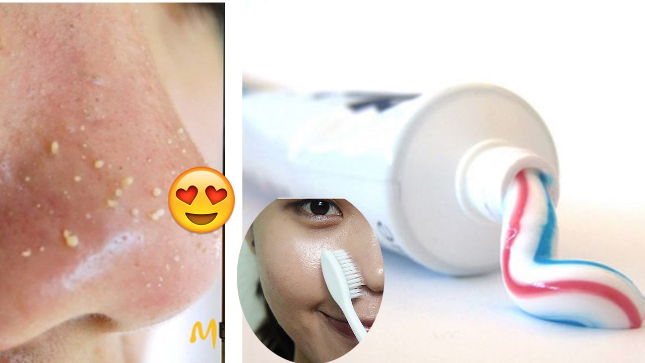 Bôi thứ này lên cánh mũi: mụn đầu đen bay sạch, lỗ chân lông se khít, da sáng bóng