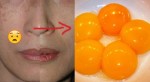Làm mờ vết NÁM, TÀN NHANG chỉ cần trứng gà cực đơn giản, cho da trắng hồng