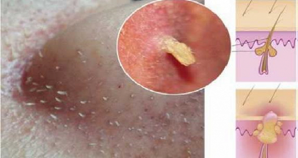 Mụn đầu đen tự khắc chui ra chỉ từ hỗn hợp sau