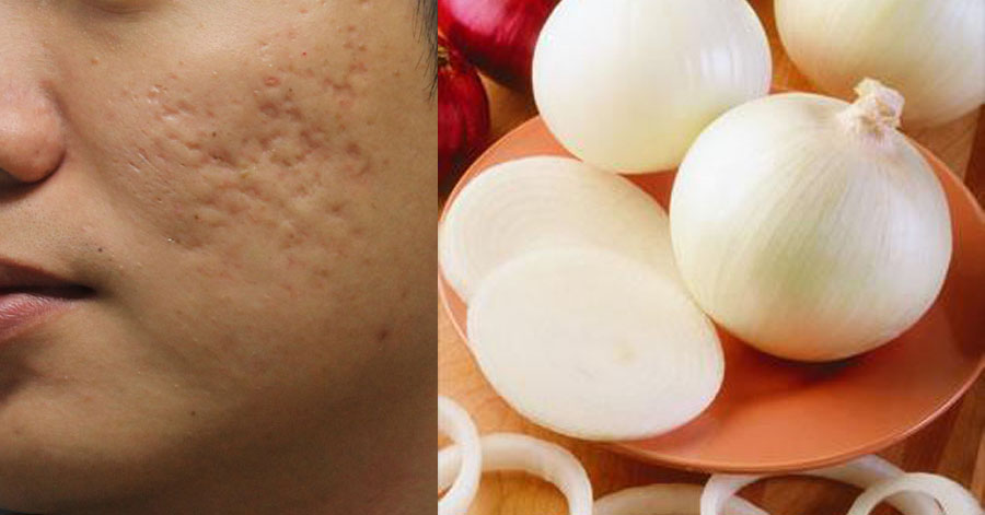 1 củ hành tây – 3 mẹo làm đẹp rẻ tiền giúp bạn lột xác đẹp rạng ngời