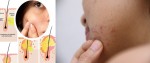 Vì sao mụn trứng cá nội tiết lại rất khó điều trị?