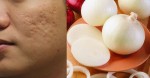 1 củ hành tây – 3 mẹo làm đẹp rẻ tiền giúp bạn lột xác đẹp rạng ngời