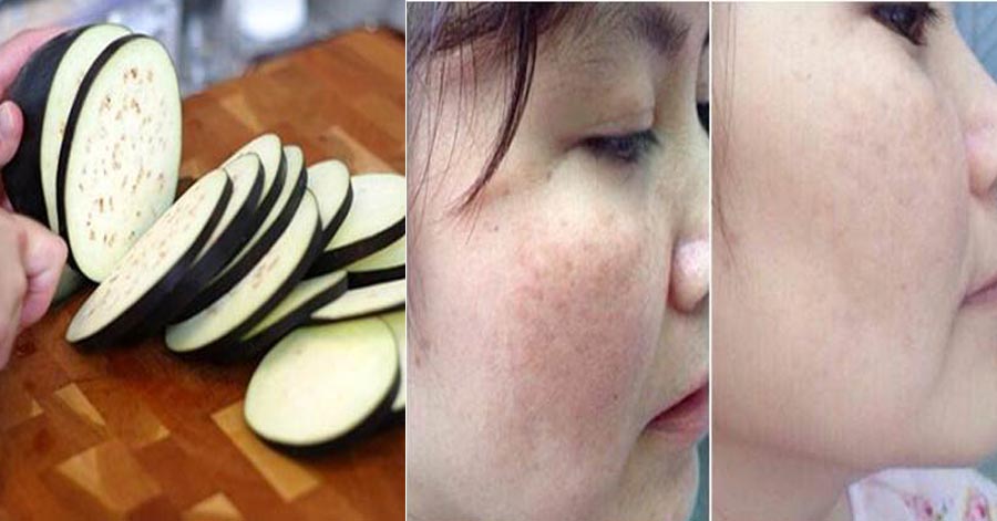 Thái lát cà tím chà lên mặt, nám da nặng đến đâu cũng phải khỏi ngay sau 1 tuần sử dụng