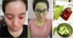 9x Review cách trị tận gốc mụn ẩn dưới da đơn giản bằng mướp đắng