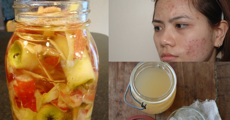 Thoa nước này lên mặt, sẹo thâm do mụn sẽ giảm dần dần