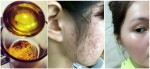 Mụn mảng hay viêm da đều biến mất nếu đắp hỗn hợp này trong 15 phút