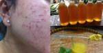 Đánh bay mụn nội tiết, mụn bọc, vết thâm nhờ 1 cốc nghệ pha như thế này