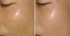 Hiểu đúng về NÁM DA để đi đến hướng điều trị “chuẩn xác” nhất