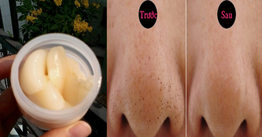 Thoa hỗn hợp này lên mũi, cồi mụn đầu đen tự chui ra đảm bảo hiệu quả tức thì