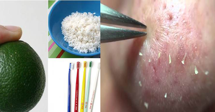 Chà nửa quả chanh lên mũi, mụn đầu đen tự khắc chui ra