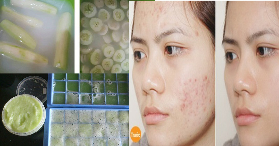 Dùng bia với dưa chuột theo cách này, giúp trắng da, trị mụn và se khít lỗ chân lông