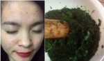 Kết hợp thứ này cùng rau diếp cá giã nát, mụn cứng đầu đến đâu cũng hết sạch đến đó