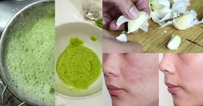 3 cách kích mụn ẩn, mụn li ti tự trồi lên khỏi mất công nặn, là con gái nên ‘’khắc cốt ghi tâm’’ ít nhất 1 cách