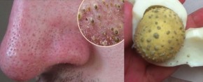 Cứ 10 người thử thì 9 người diệt sạch mụn đầu đen với 1 quả trứng gà luộc