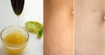 100 mẹ bầu đã thử và thành công với cách trị rạn da sau sinh bằng 1 quả chanh