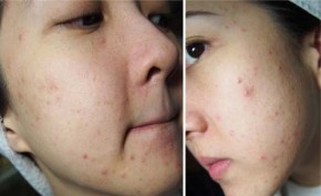 Chị em mắc phải 5 thói quen này khiến mụn mọc như nở hoa trên mặt