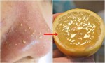 Trộn 2 thứ này rồi đổ lên nửa quả chanh chà lên mặt, chà đến đâu mụn đầu đen trồi lên đến đó