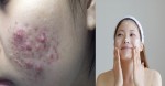 Nếu cứ tiếp tục 5 điều này, mụn sẽ “nở hoa đầy mặt” đấy