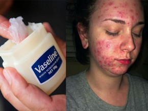 Đừng quá tôn sùng Vaseline mà không biết đến những tác hại này của chúng trong làm đẹp