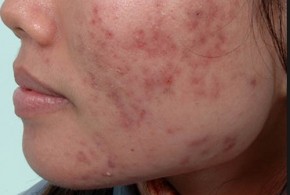 Gột sạch sành sanh mụn cùng vết thâm nhờ nước dừa pha cùng mật ong