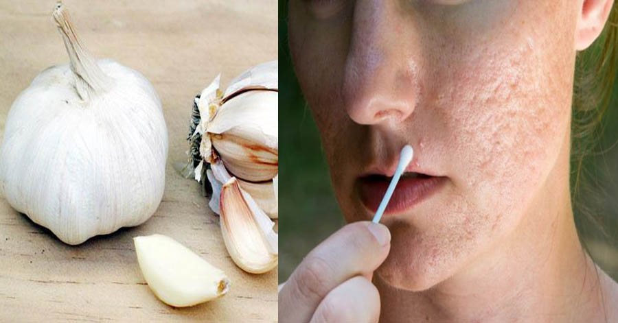3 công thức trị khỏi “sẹo lõm” dành cho cả những người bị sẹo lâu năm