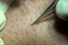 Lông nách mọc li ti, ngứa ngáy mà không có thời gian nhổ, bạn cứ thoa thứ này là lông tự rụng ngay