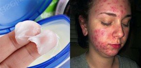 Sáp nẻ (Vaseline) không thần thánh trong việc làm đẹp nó gây ra những tác hại thế này cơ mà