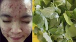 Trộn thứ này với rau diếp cá giã nát, mụn cứng đầu đến đâu cũng hết sạch đến đó