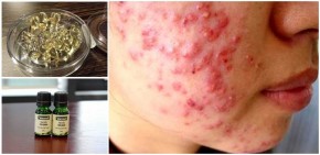 Đầu tuần mặt chi chít mụn và vết thâm, cuối tuần mặt “láng o”, trắng mịn chỉ cần thoa thứ này là đủ