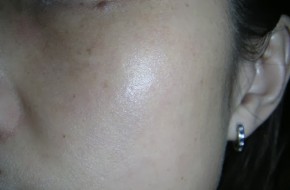 Muốn HẾT SẠCH NÁM, hãy thử với cách trị nám da mặt NHANH NHẤT QUẢ ĐẤT này