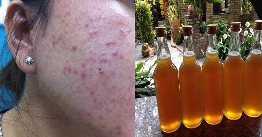 Đánh bay mụn nội tiết, mụn bọc, vết thâm nhờ 1 cốc nghệ pha như thế này