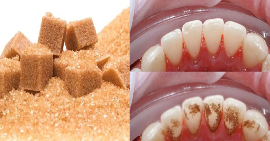 Cao răng "diệt sạch", hôi miệng hết hẳn nhờ ngậm nước này trước khi đi ngủ