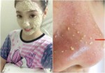 Mụn chìm hay mụn ẩn dưới da tự khắc chui ra nhờ đắp thứ này, không cần phải đi Spa