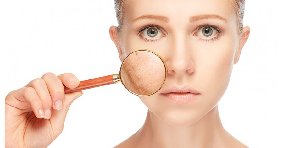 Bí quyết trị nám sắc tố đơn giản, mang lại hiệu quả cao