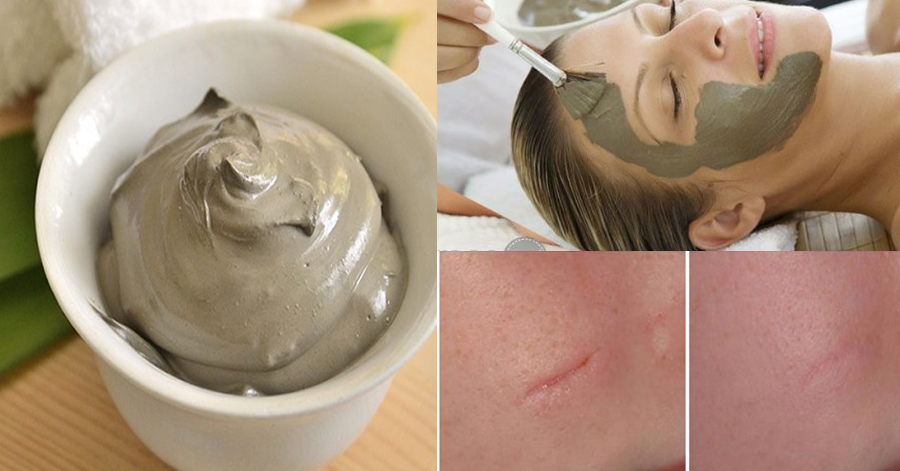 Sẹo dù to cỡ nào, lâu năm đến mấy, cứ bôi hỗn hợp này lên là hết ngay