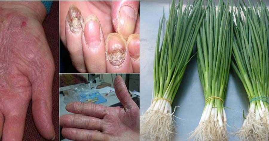 Thổi bay viêm da cơ địa, vảy nến, á sừng lâu năm chỉ bằng 1 nắm rau dễ tìm ngoài chợ