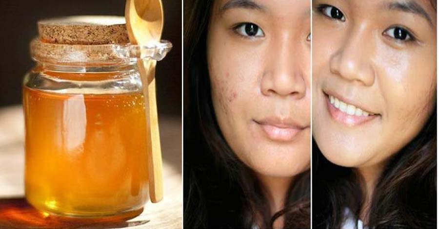 Chấm vài giọt mật ong lên vết sẹo, bạn sẽ bất ngờ về kết quả
