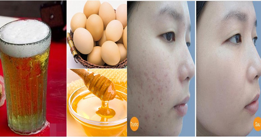 Không cần kem trị mụn bạc triệu, chỉ với 1 lon bia có ngay 3 công thức khiến mụn tự khắc chui ra