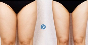 Đùi to, chân mập cũng thon gọn siêu tốc chỉ trong 1 tuần nhờ vài thìa muối