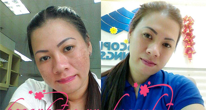 Nám da do di truyền và nội tiết tố, loại nám nào dễ điều trị hơn?