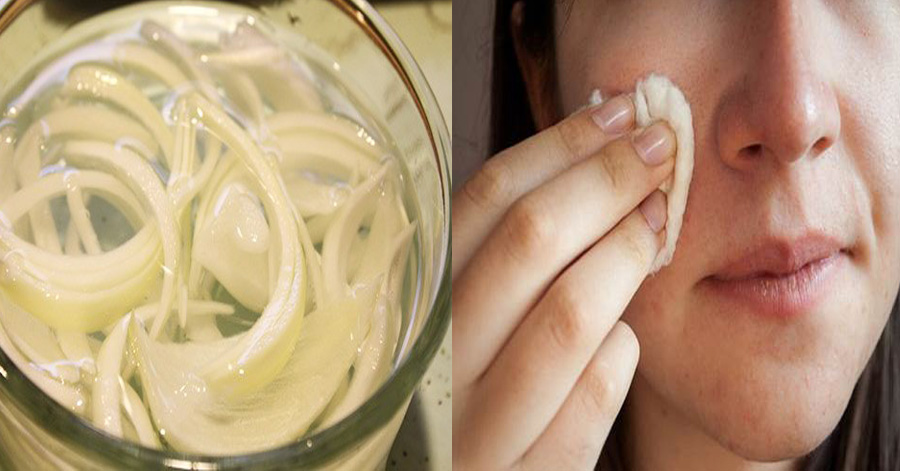 Ngâm hành tây với giấm rồi dùng dung dịch này chấm lên nốt tàn nhang, bạn sẽ bất ngờ với kết quả