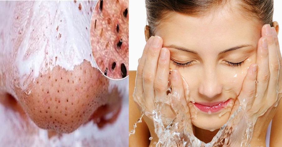 1 thìa kem đánh răng và 1 bàn chải, bạn sẽ "tiêu diệt" triệt để mụn đầu đen