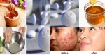 Cách dùng aspirin để lột ra cả trăm mụn trứng cá trắng xóa trên mặt không cần nặn đau đớn