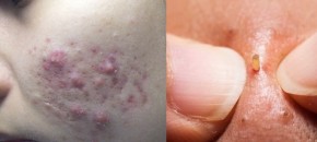 Mụn sẽ “nở hoa” khiến “cuộc sống bế tắc” nếu bạn tiếp tục thực hiện 6 thói quen này