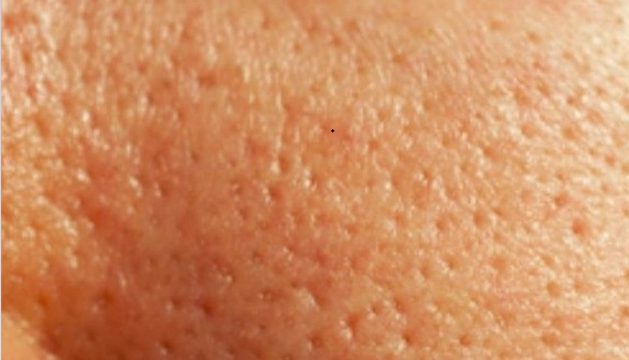 Thực hiện các bước chăm sóc, lỗ chân lông có to mức nào cũng se khít nhanh chóng