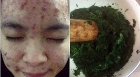 2 công thức cho da mụn và vết thâm hồi sinh trắng bóc, căng láng như em bé