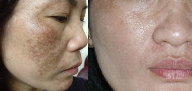 NÁM DA THUỘC LOẠI NÀO THÌ "VÔ PHƯƠNG CỨU CHỮA?"