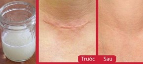 Sẹo kiểu gì cũng đều mờ dần với củ hành tím khỏi cần thuốc thang